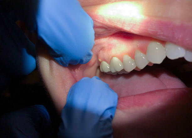 Best Emergency Broken Tooth Repair in Valatie, NY